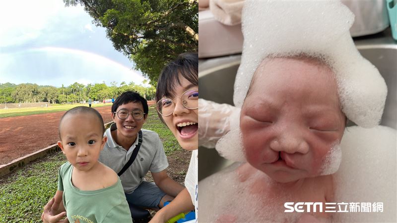 【三立新聞/鏡週刊】生下唇腭裂兒　曝2次手術對比照：不後悔