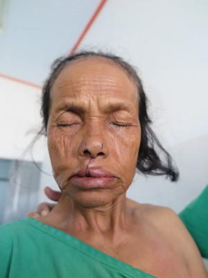 【中時電子報】台灣之光－脣顎裂義診 59歲婦拾回顏面