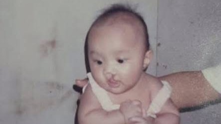 唇腭裂絕不是人生的限制