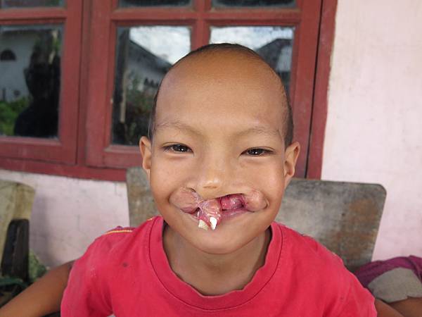 四次手術失敗 印尼男孩Novel懷抱最後一絲希望赴台