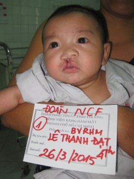 一趟義診,改變黎小弟的顏面缺陷