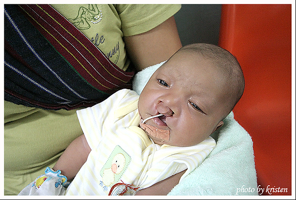 這麼小,怎麼辦?寮國義診每日一照