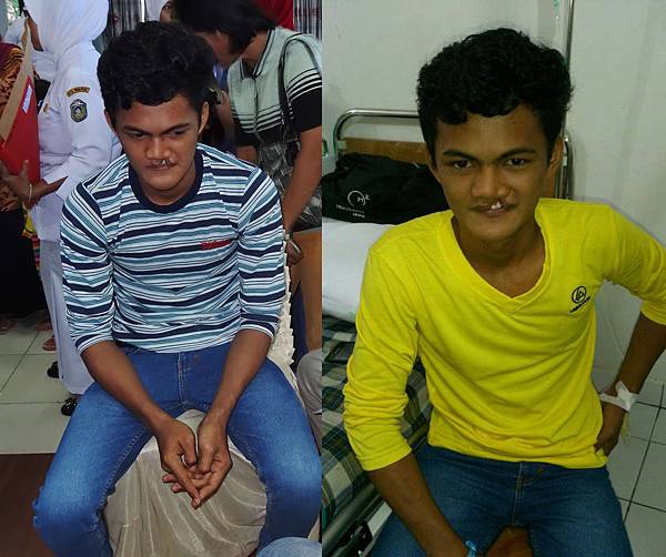 術前術後 術前術後