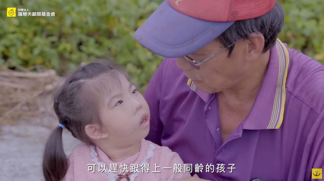 真實故事 | 臺灣顱顏患童 4歲小華 巨口症